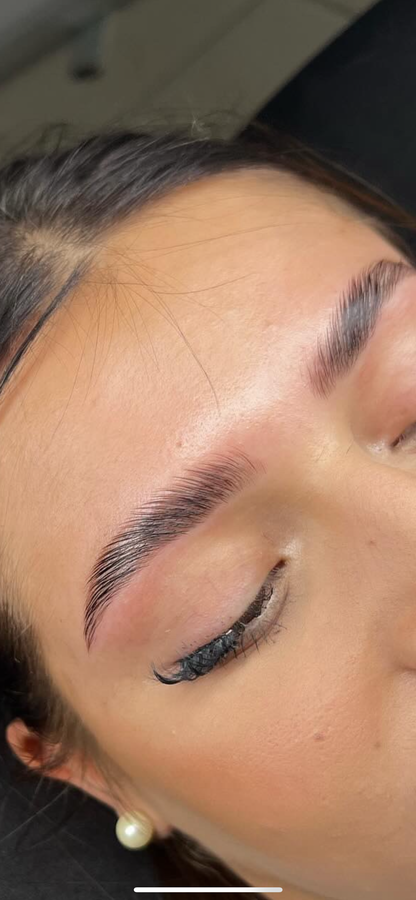 BROW LIFT